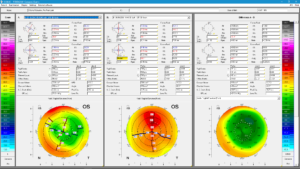oculus pentacam software