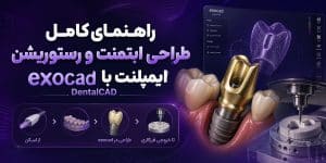 راهنمای کامل طراحی ابتمنت و رستوریشن ایمپلنت